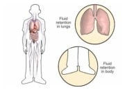 How diuretics work in heart failure
